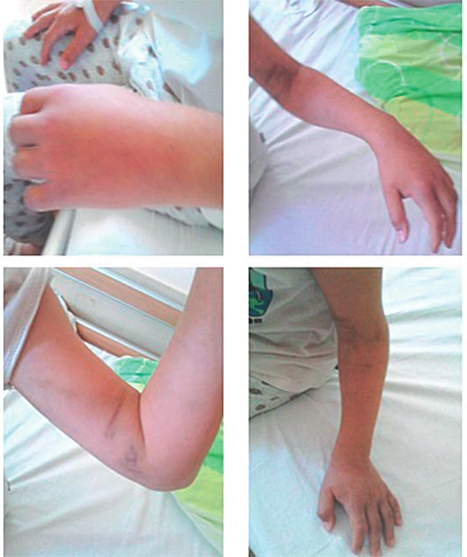 10-ročný chlapec po envenomácii do palca ľavej hornej
končatiny.
A – Lokálny opuch ruky. B – Lokálny opuch s miernou
hemorágiou bez hematologických abnormalít.
C – Progresia edému na celú ľavú hornú končatinu
až do axily, bez neurocirkulačnej poruchy (USG). D –
Regresia edému na 6. deň symptomatickej liečby.<br>
Fig. 5. 10-year-old boy after envenomation to the left upper
limb.
A – Local swelling of the hand. B – Local swelling with
mild haemorrhage without haematological abnormalities.
C – Edema progression to the entire left upper
limb up to the axilla, without neurocirculatory disorder
(USG ). D – Regression of edema on the 6th day of
symptomatic treatment.