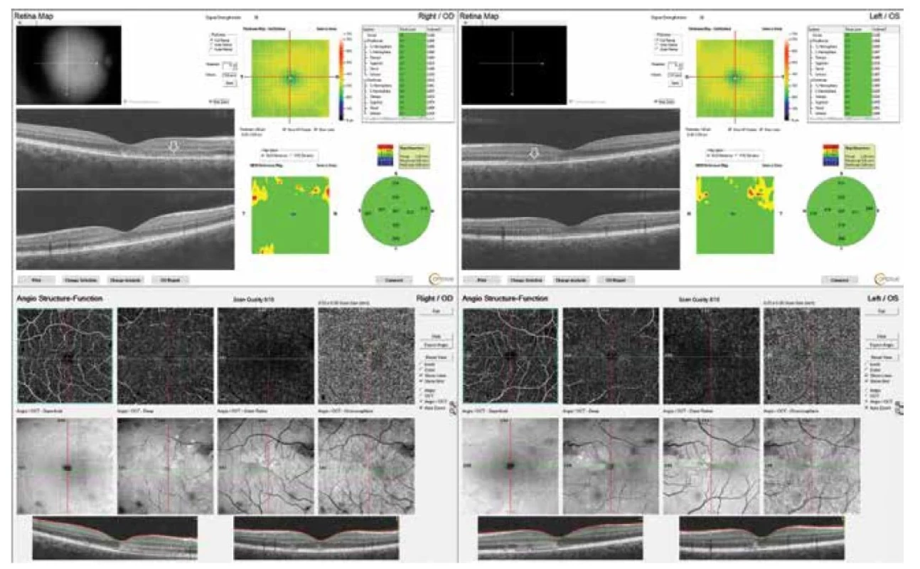 Na kontrolnom OCT vyšetrení nasledujúci deň sa zobrazuje široký hyperreflexný pás (biele šípky) na úrovni vonkajšej
jadrovej vrstvy a vonkajšej plexiformnej vrstvy charakteristický pre akútnu makulárnu neuroretinopatiu (A, B). OCTA zobrazuje
typické petaloidné lézie s hyperreflexným pásom v korešpondujúcom mieste parafoveolárnych lézií (C, D)