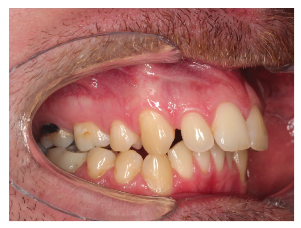 a Laterálně zkřížený skus
u pacienta po extrakci
horních premolárů a se
zvětšeným incizálním
schůdkem<br>
Fig. 5a Lateral cross bite in patient
with extracted upper first
premolars and increased
overjet