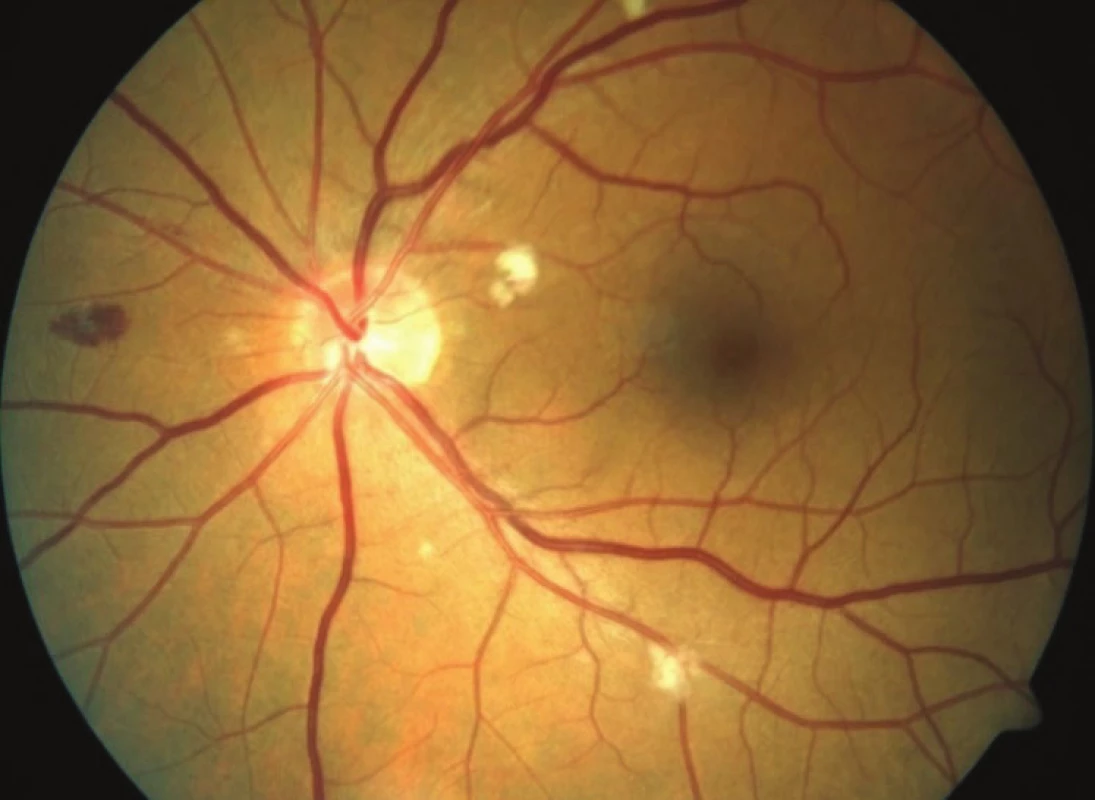 HIV microvasculopathy and retinopathy - haemorrhage, cotton
wool spots, small microaneurysms