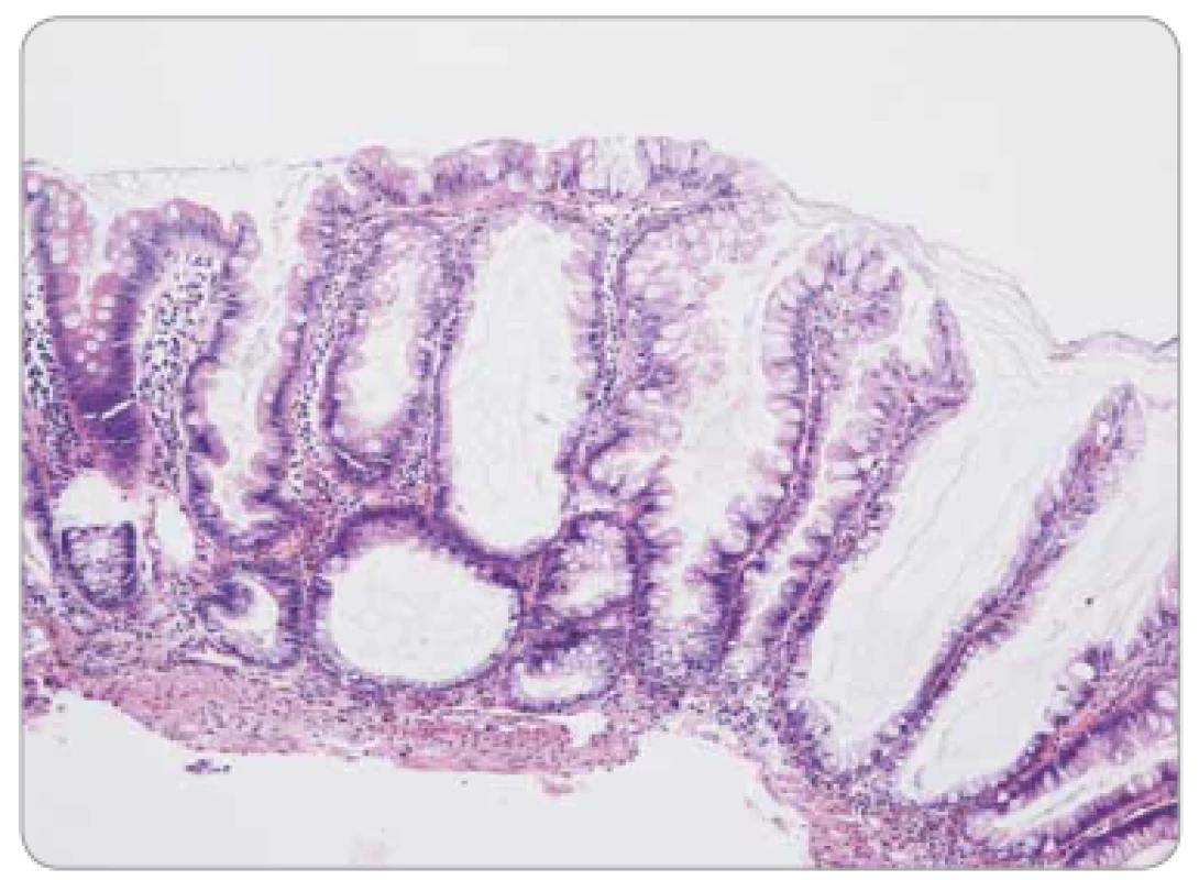 Sesilní serrated adenom/polyp tračníku – pilovité uspořádání
epitelu v celé délce bazálně dilatovaných krypt.