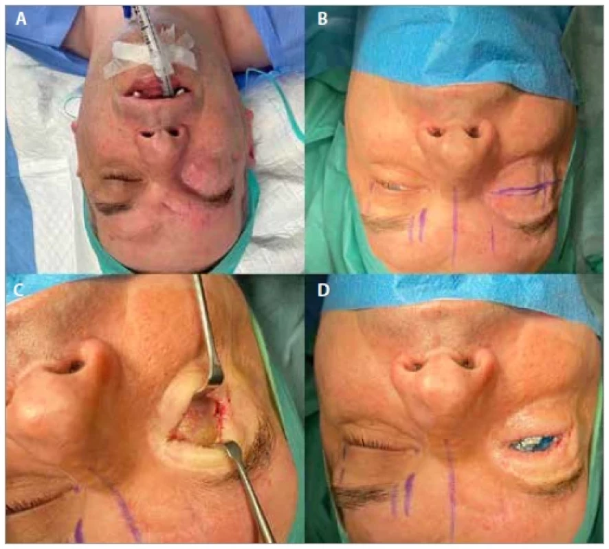 (A) State before the eyelids reconstruction; (B) surgical markings;
(C) opening of the conjuctival sac; (D) temporary eye prosthesis.