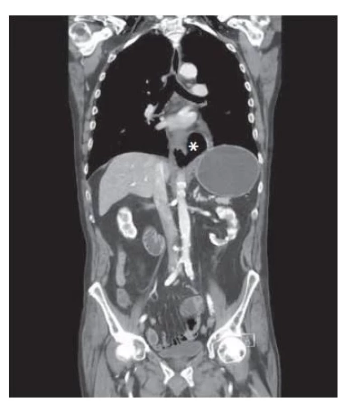 Na koronárním CT řezu vidíme
obraz pneumomediastina, jícen je
zkolabovaný.<br>
Hvězdička označuje
pneumomedistinum.<br>
Fig. 1. On the coronary CT section we
see the image of pneumomediastinum,
the esophagus is collapsed.<br>
An asterisk indicates
pneumomediastinum.