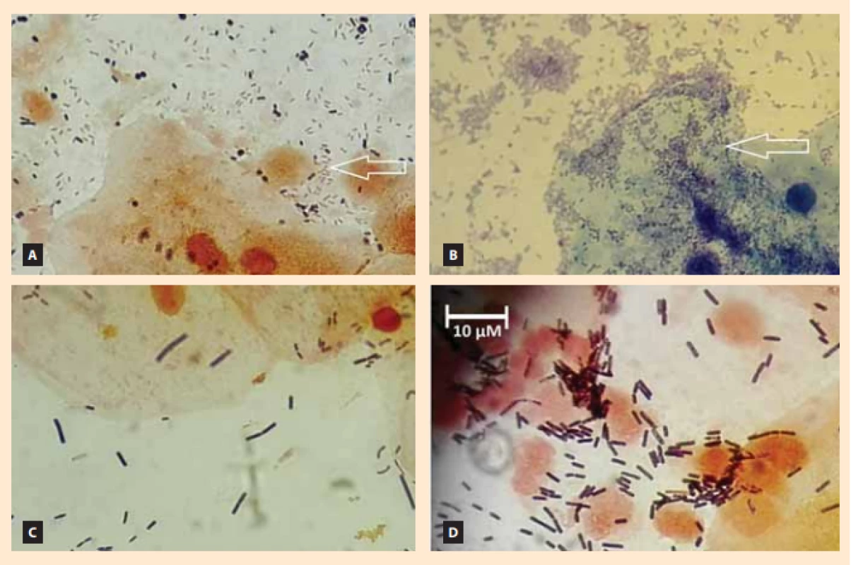 Representative micrograms of the vaginal environment.
For each patient, one slide was stained by Giemsa-Romanowsky and the other by Gram stain. The slides were assessed using an oil
immersion lens, providing total magnifi cation of 1,000X. Nugent scores (NS) were determined according to Nugent et al [22]. Panels 
A and B represent a microscopic image of bacterial vaginosis. Panels C and D show a normal environment. Panel A: NS = 10 (2+, 4+, 
3+); Panel B: NS = 8 (0, 4+, 0) is a typical Gardnerella infection; Panel C: NS = 1 (3+, 0, 0); Panel D: NS = 0 (4+, 0, 0) with frequent rod-
-like Lactobacillus. The arrows indicate high diversity mucosal flora typical for higher NS.<br>
Obr. 1. Reprezentativní mikroskopické snímky vaginálního prostředí.
U každé pacientky byly provedeny dva stěry, jeden byl obarven dle Giemsy-Romanowského a druhý dle Grama. Roztěr na sklíčku 
byl odečten imerzním objektivem pod 1 000násobným celkovým zvětšením. Nugentovo skóre (NS) bylo spočteno dle Nugenta 
et al [22]. Panely A a B představují pacientky s mikroskopickým obrazem bakteriální vaginózy. Panely C a D ukazují normální prostředí. Panel A: NS = 10 (2+, 4+, 3+); Panel B: NS = 8 (0, 4+, 0) je typickou infekcí bakterie Gardnerella; Panel C: NS = 1 (3+, 0, 0); Panel D: 
NS = 0 (4+, 0, 0) s častými tyčinkami rodu Lactobacillus. Šipky ukazují smíšenou slizniční flóru typickou pro zvýšené NS.