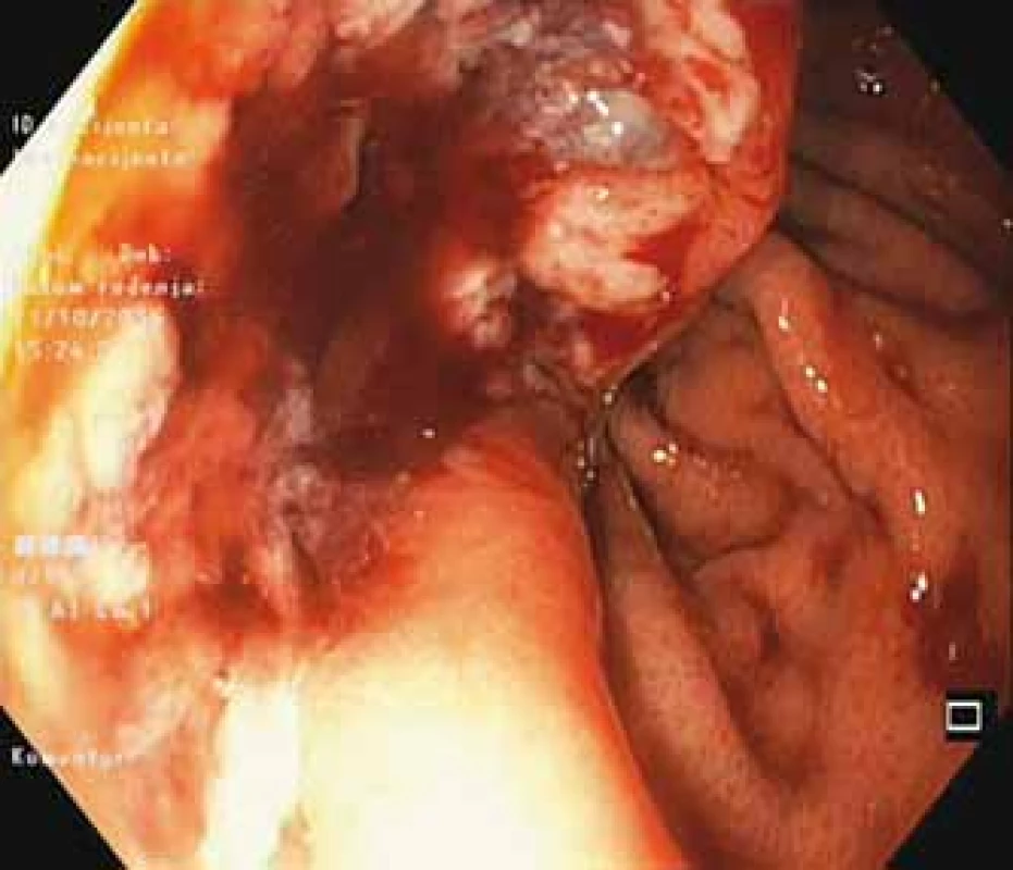 Endoscopic appearance of gastrointestinal
stromal tumor.
