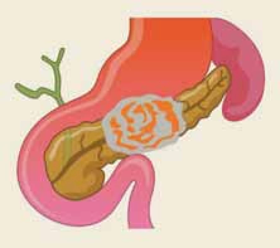 Akutní nekrotizující pankreatitida v oblasti těla pankreatu zahrnující hlavní pankreatický vývod
– ilustrace.<br>
Fig. 1. Acute necrotizing pancreatitis
in the body of the pancreas containing
the main pancreatic duct – an illustration.