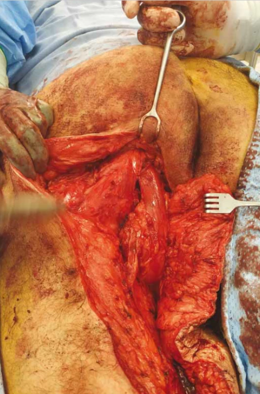 Biceps femoris muscle and semitendinosus muscle sutured
into the defect.<br>
Obr. 3. Musculus biceps femoris a semitendinózní sval všití do defektu.