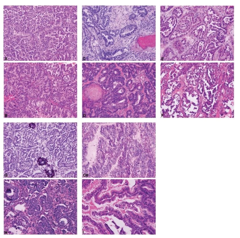 Ukázky peroperačního a definitivního vyšetření pěti nejčastějších histologických typů ovariálních karcinomů.<br>
A – high grade serózní karcinom (peroperační
vyšetření, HE, 200x); B – high grade serózní karcinom
(definitivní vyšetření, HE, 200x); C – endometroidní
karcinom (peroperační vyšetření, HE,
200x); D – endometroidní karcinom (definitivní
vyšetření, HE, 200x); E – světlobuněčný karcinom
(peroperační vyšetření, HE, 200x); F – světlobuněčný
karcinom (definitivní vyšetření, HE, 200x);
G – low grade serózní karcinom (peroperační
vyšetření, HE, 200x); H – low grade serózní karcinom
(definitivní vyšetření, HE, 200x); CH – mucinózní
karcinom (peroperační vyšetření, HE,
200x); I – mucinózní karcinom (definitivní vyšetření,
HE, 200x)