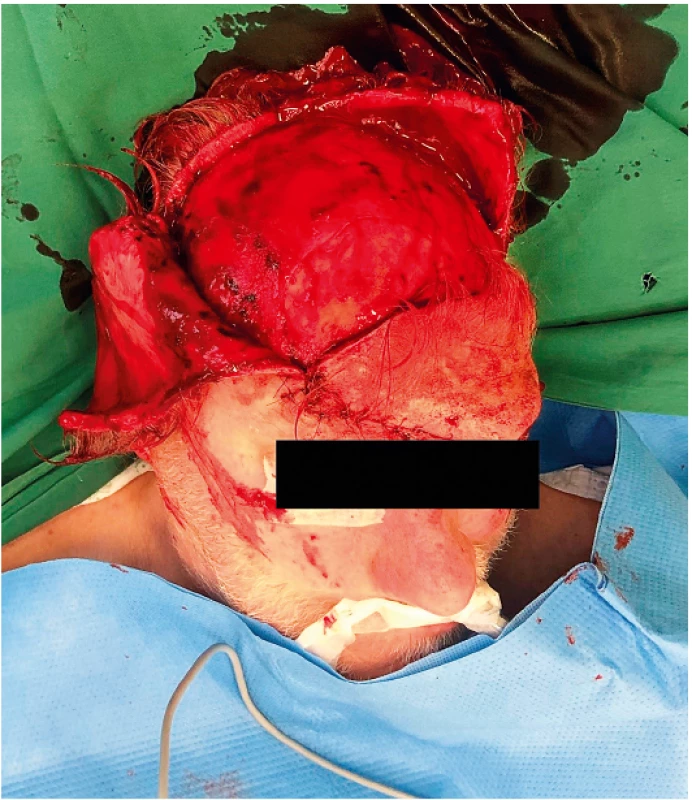 Ring-shaped re-excision including the underlying periosteum