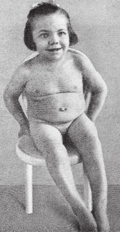 Dívka s neléčenou těžkou vrozenou hypotyreózou ve věku 14 let (tzv. sporadický kretenismus) – převzato z [1].<br>Fig. 2. Untreated case of severe congenital hypothyroidism at the age of 14 years (i.e. sporadic cretenism) – adapted from [1].