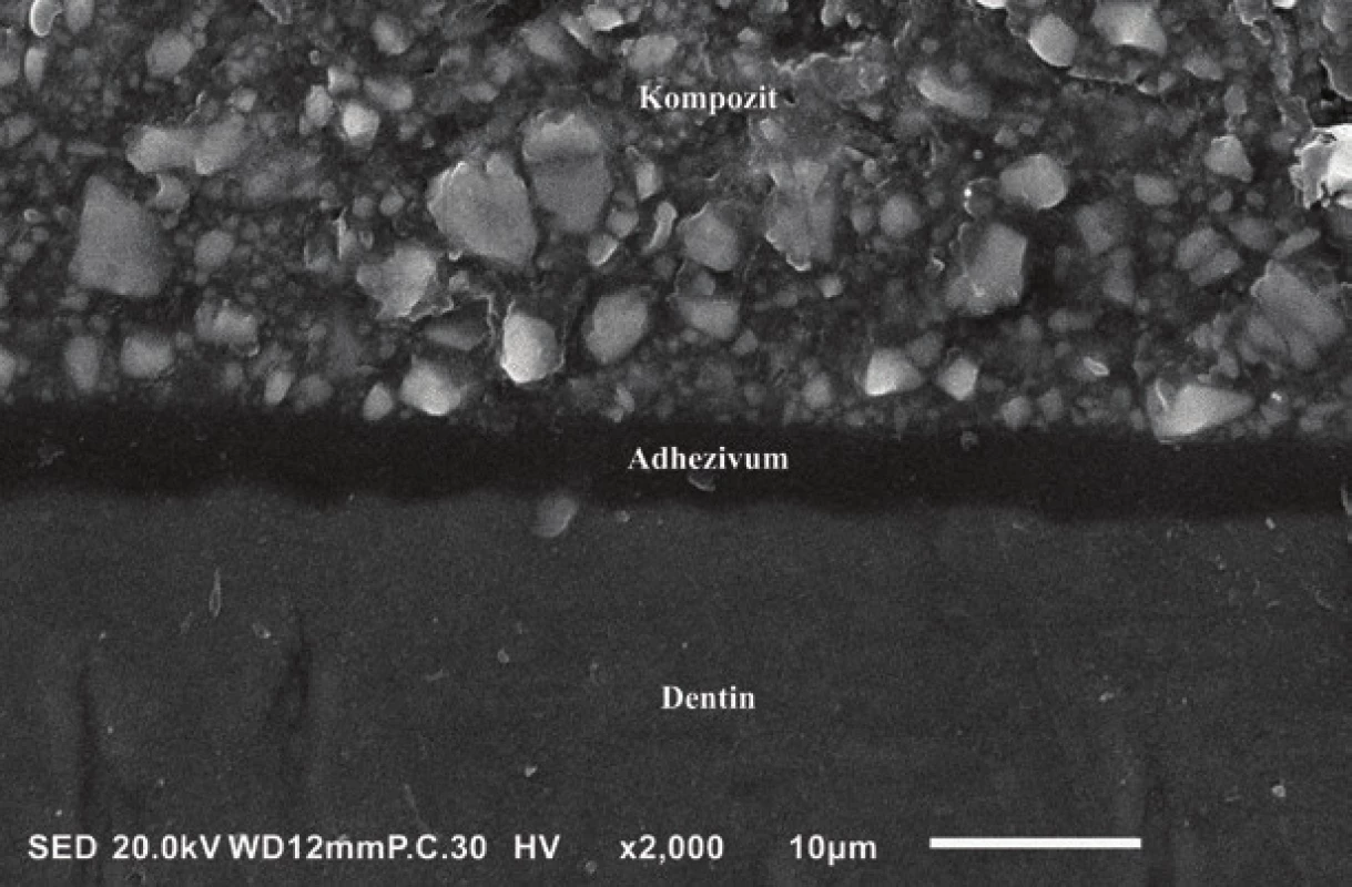 Příčný řez adhezním spojem
mezi dentinem a hybridním
kompozitem s tenkou
(~5 μm) vrstvou
univerzálního adheziva
G-Premio Bond (GC, Tokio,
Japonsko).
Skenovací elektronový
mikroskop, zvětšení 2000×.<br>
Fig. 3
A cross-sectional view
of the adhesive joint between
dentin and a hybrid resin
composite formed by a thin
(~5 μm) adhesive layer
of the universal adhesive
G-Premio Bond
(GC, Tokyo, Japan).
Scanning electron microscope,
magnification 2000×.