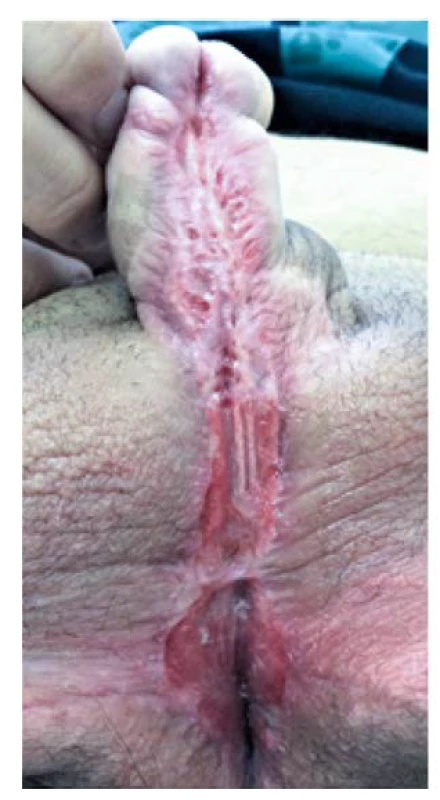 Uretrální ploténka tři měsíce po
dermatologické léčbě<br>
Fig. 3. Urethral plate three months
after dermatological treatment