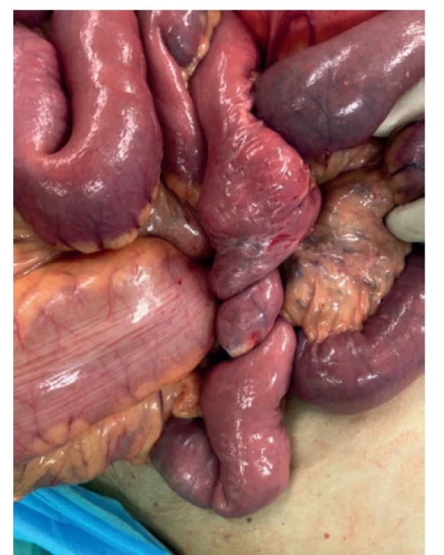 Volvulus na tenkém střevě<br>
Fig. 3: Small bowel volvulus
