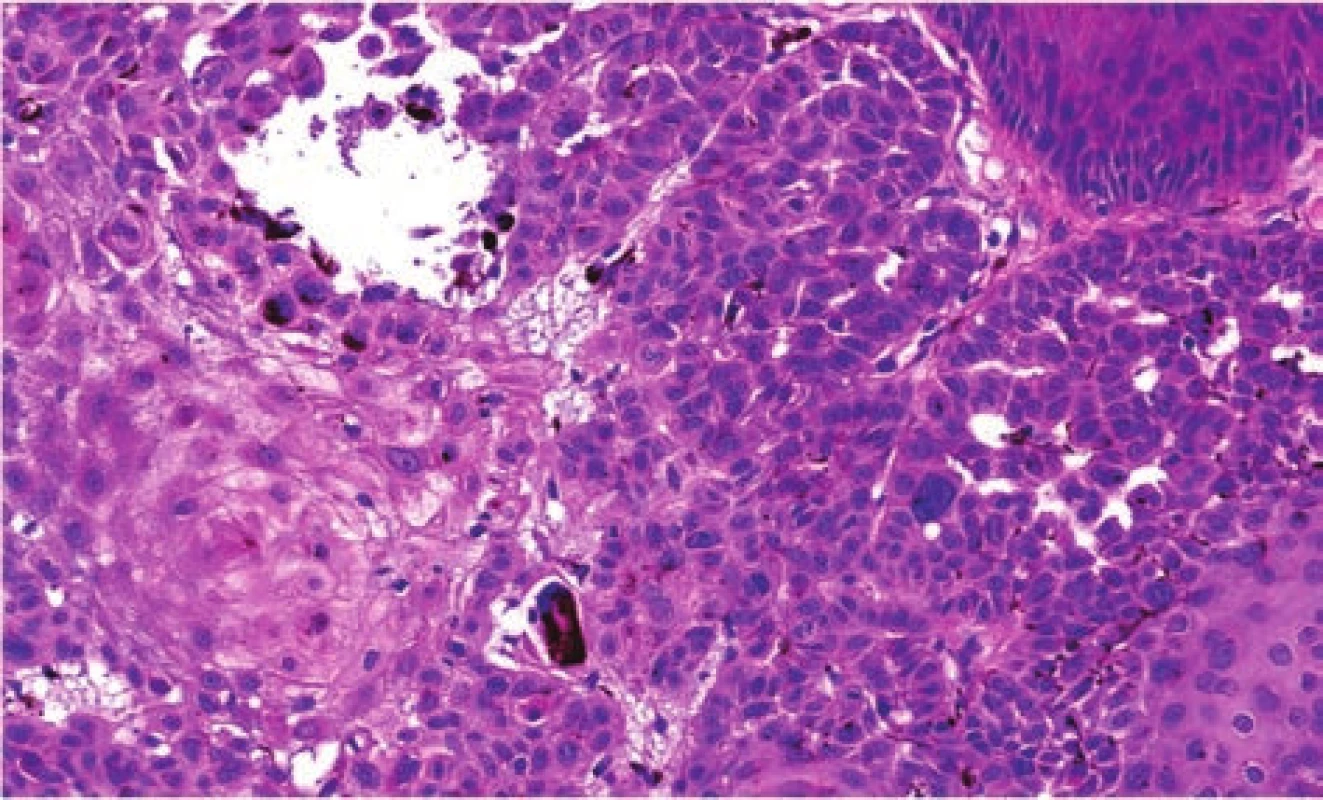 Nádorový čep obsahuje v centru větší eozinofilní keratinocyty, na periferii zčásti bazaloidní, s  hyperchromními
jádry a zvětšeným obsahem melaninu v cytoplazmě
(HE, zvětšeno 200 x)