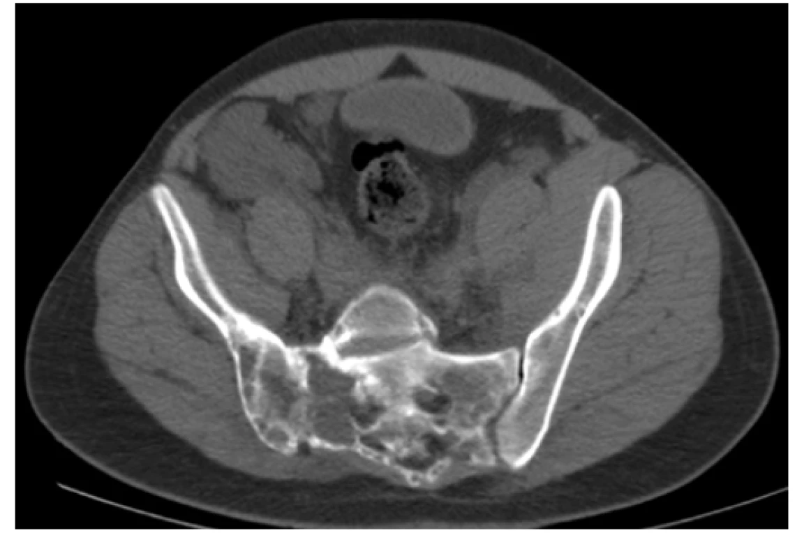 CT scan (axiální rovina), kostní okno – osteolytické změny vystupňované
vpravo v oblasti SI skloubení