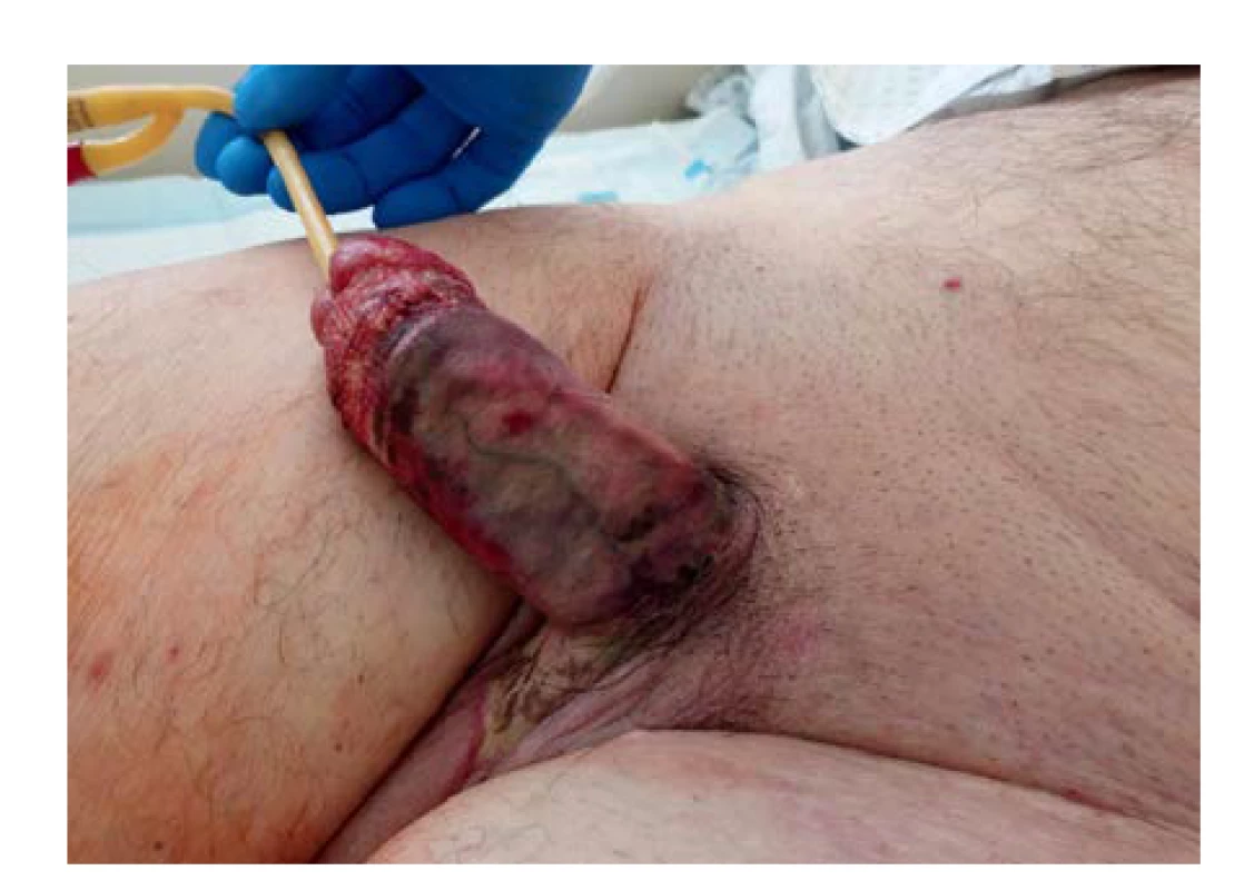 Nekróza kožního krytu penisu, předkožky i penoskrotální
oblasti společně s uretrou před nekrektomií<br>
Fig. 3. Necrosis of the penile skin, prepuce as well as the
penoscrotal region with the urethra prior to necrectomy