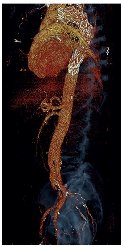 Částečná explantace stentgraftu s náhradou TAAA II
(CT-AG)<br>
Fig. 8: Partial stent-graft explantation with TAAA II reconstruction
(CT-AG)