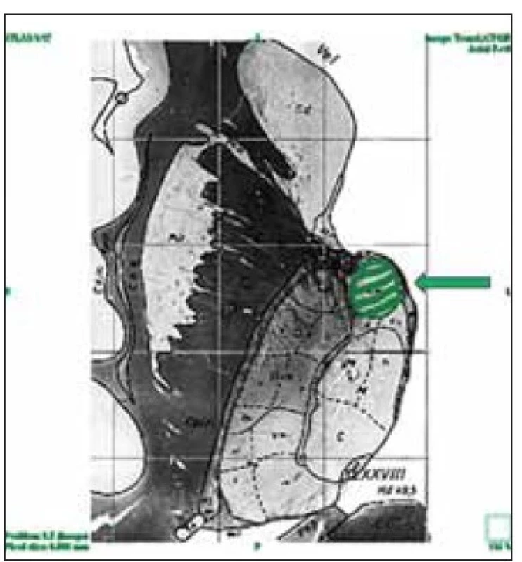 Poloha nucleus anterior thalami
(ohraničeno zeleně) ve vztahu ke strukturám
komorovému systému (převzato
z elektronického atlasu Schaltenbrand
Bailey).<br>
Fig. 1. The position of the anterior thalamic
nucleus (green borders) and its relationship
to the structures of the ventricular
system (modified from the Schaltenbrand
Bailey e-atlas).