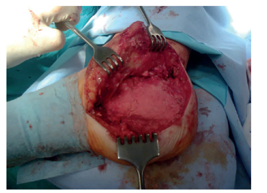 Kostní defekt vyplněn spongioplastikou v druhé
etapě metody podle Masqueleta po extrakci cementového
spaceru<br>
Fig. 8: Bone defect filled with autologous cancellous bone
graft in the second stage of the Masquelet technique after
removal of the cement spacer