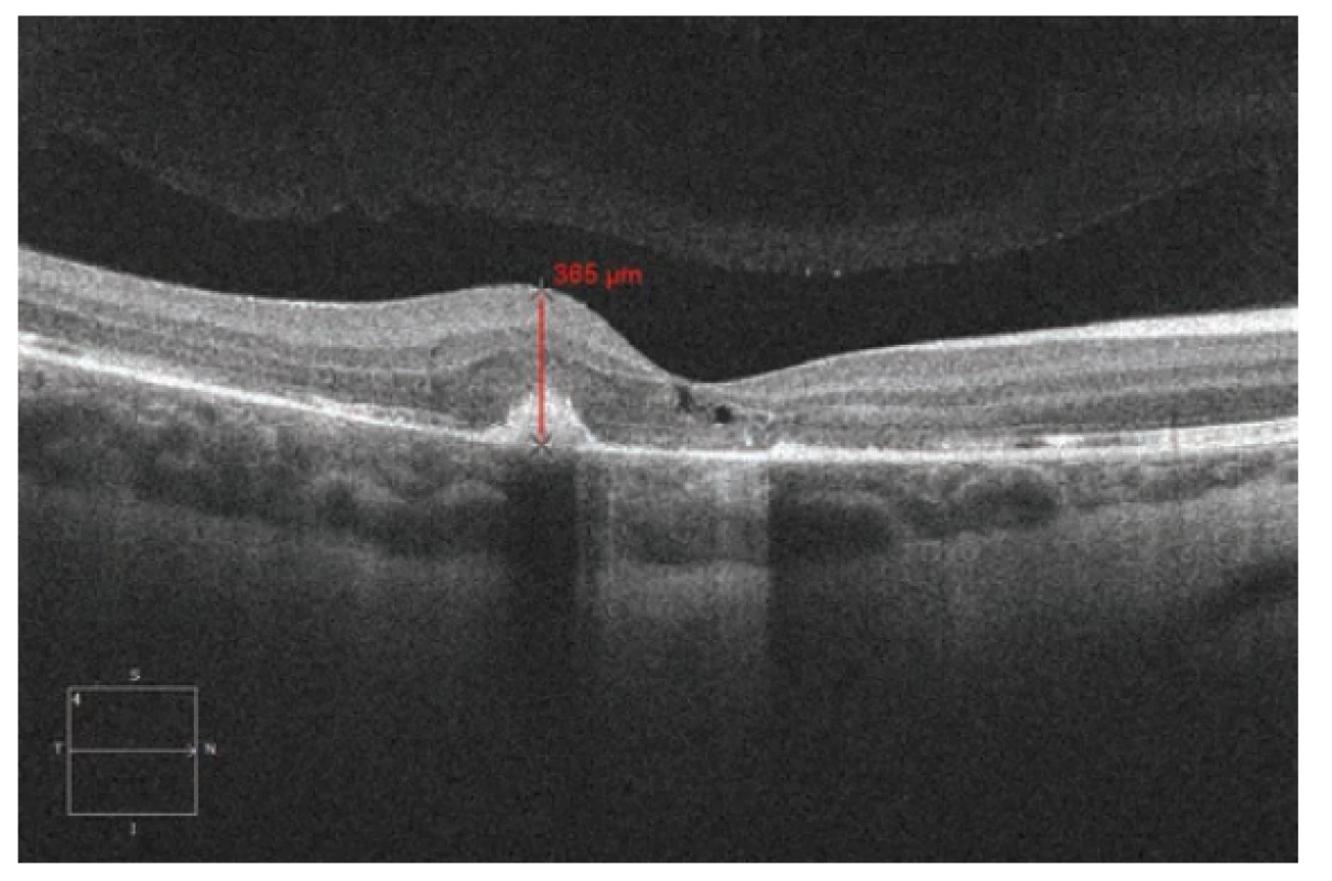 Spektrální HD OCT Lineární horizontální makulární sken
po 3. intravitrálních aplikacích ranibizumabu (Lucentis) v měsíčních
intervalech pro CNV s výraznou regresí makulární tloušťky a objemu.
Regrese makulární tloušťky juxtafoveolární oblasti z 680 μm
na 365 μm
