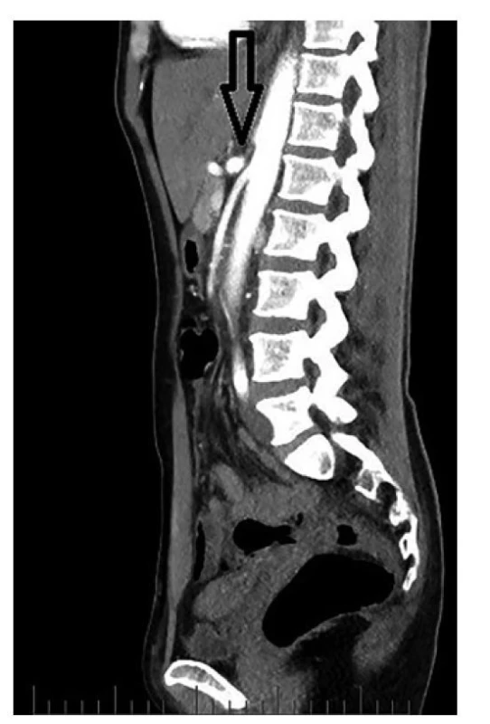 Útlak truncus coeliacus (CT-AG)<br>
Fig. 1: Coeliac trunk compression syndrome (CT-AG)