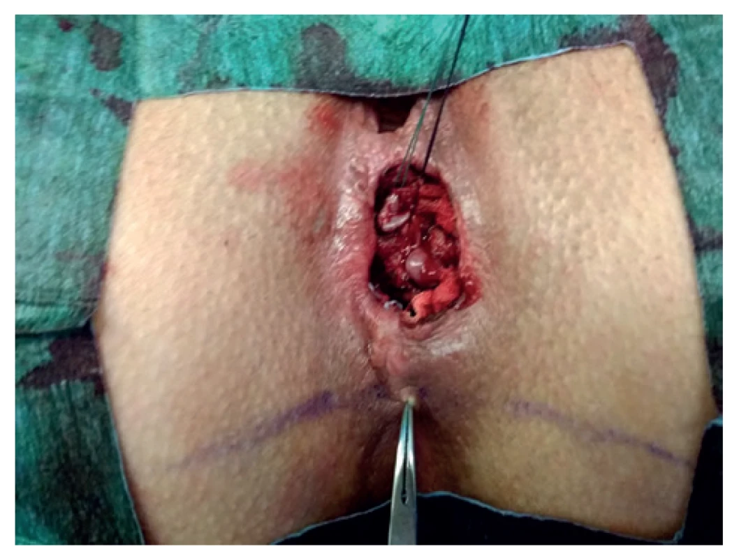 Vypreparována perineální píštěl<br>
Fig. 3: Prepared perineal fistula