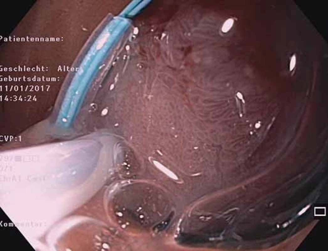 EGD – endoloop a polypektomická klučka nasadené na báze stopky polypu.<br> Fig. 6. EGD – endoloop and a polypectomy snare on a polyp pedicle base.