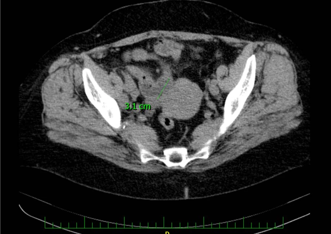 CT vyšetření zachycující intraluminální expanzi v augmentovaném močovém měchýři<br>
Fig. 4. CT examination capturing intraluminal expansion in the augmented bladder