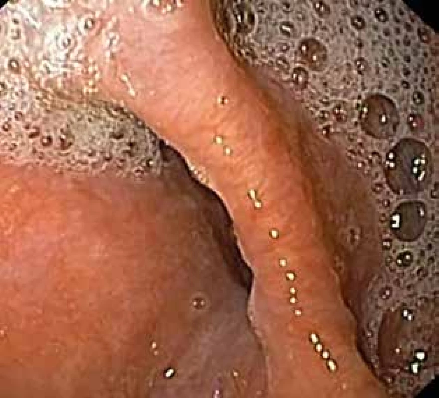Zenkerův divertikl – endoskopický pohled na septum <br>Fig. 1: Zenker‘s diverticulum – endoscopic view of the septum
