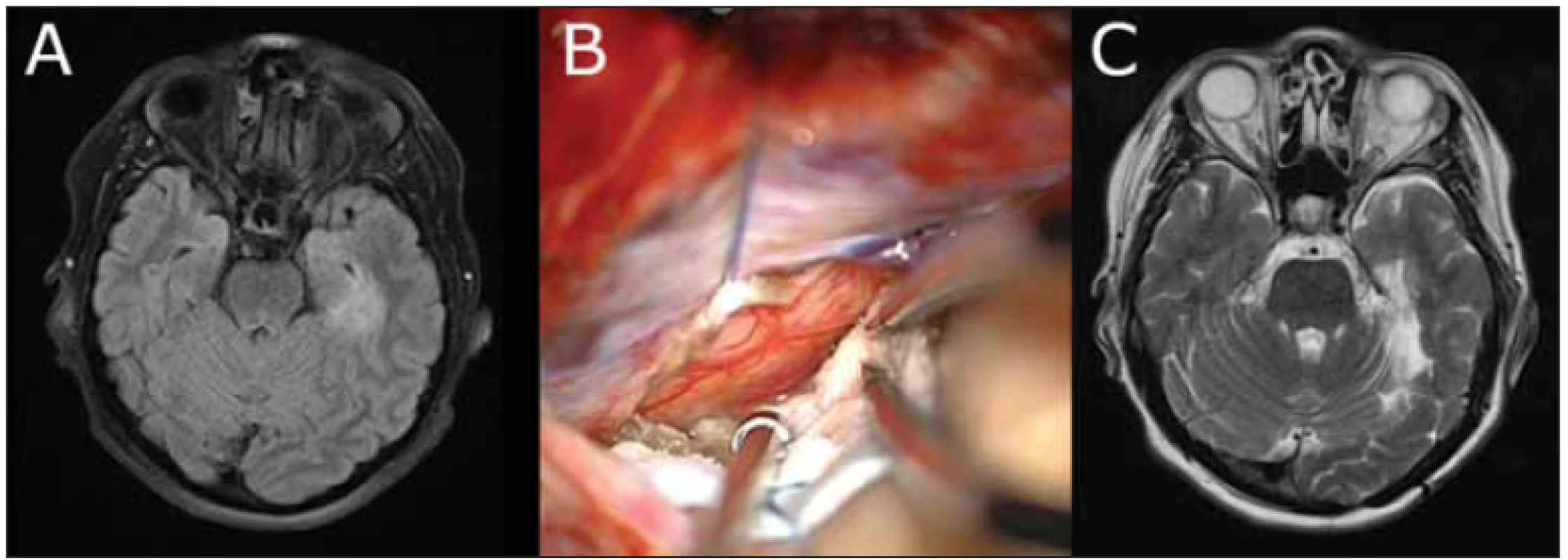 Snímky zobrazující průběh léčby 34leté pacientky s mediotemporálním nízkostupňovým gliomem. <br>
Fig. 3 Images showing the course of treatment of a 34-year-old female with mesiotemporal low-grade glioma. 