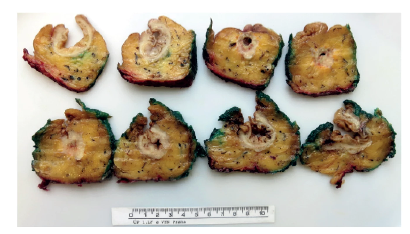 Preparát rekta s karcinomem prokrájený patologem<br>
Fig. 4: Specimen of rectum with tumor sliced by pathologist