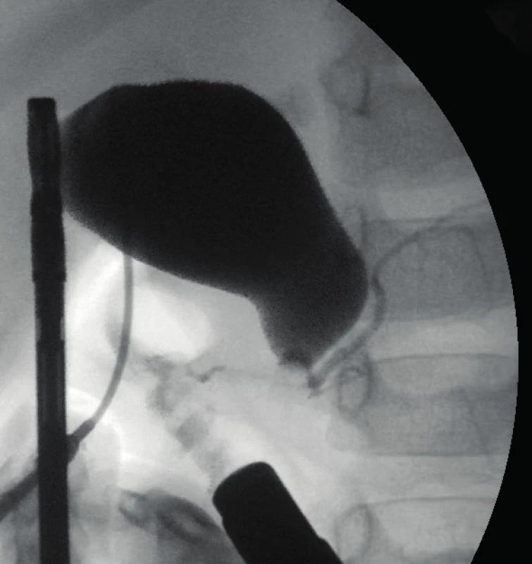 Peroperačný cholangiogram s prítomnosťou žlčových
cestiček.<br>
Fig. 6. Perioperative cholangiogram with presented bile
ducts.
