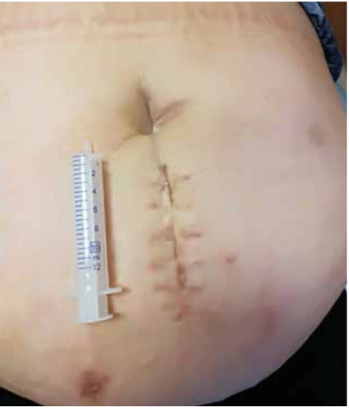 Kožní jizva 6 týdnů po HALS nefrektomii pro tumor u obézní pacientky (BMI 45,9)<br>
Fig. 4: Skin scar 6 weeks after HALS nephrectomy for renal tumor in an obese patient (BMI 45.9)
