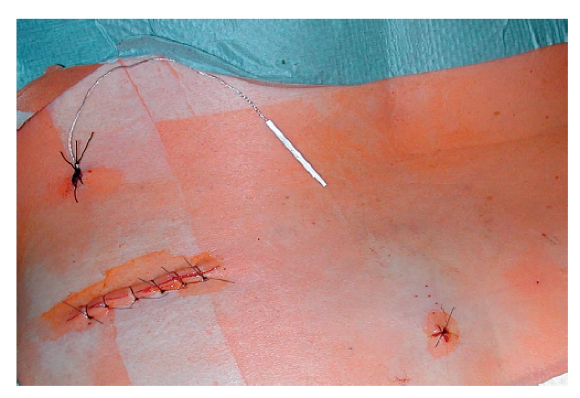 Drát napojený na elektrodu v podkožní kapse a vyvedený
zevně pro spojení s dočasným zevním neurostimulátorem<br>
Fig. 3: Extension lead connected to the electrode in the
subcutaneous pocket and withdrawn to be connected to
temporary external neurostimulator