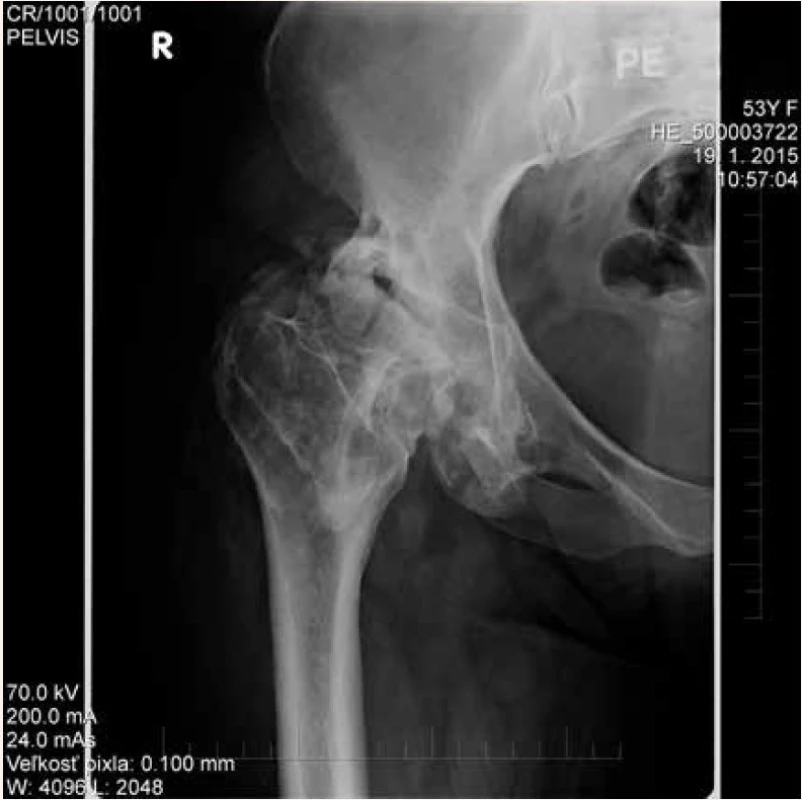 Stav po parciálnej exstirpácii heterotopických osifíkátov v teréne lokálnej osteoporózy s rozvojom nekrózy hlavy femuru