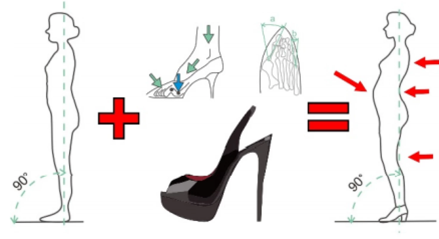 The effect of shoes on posture.