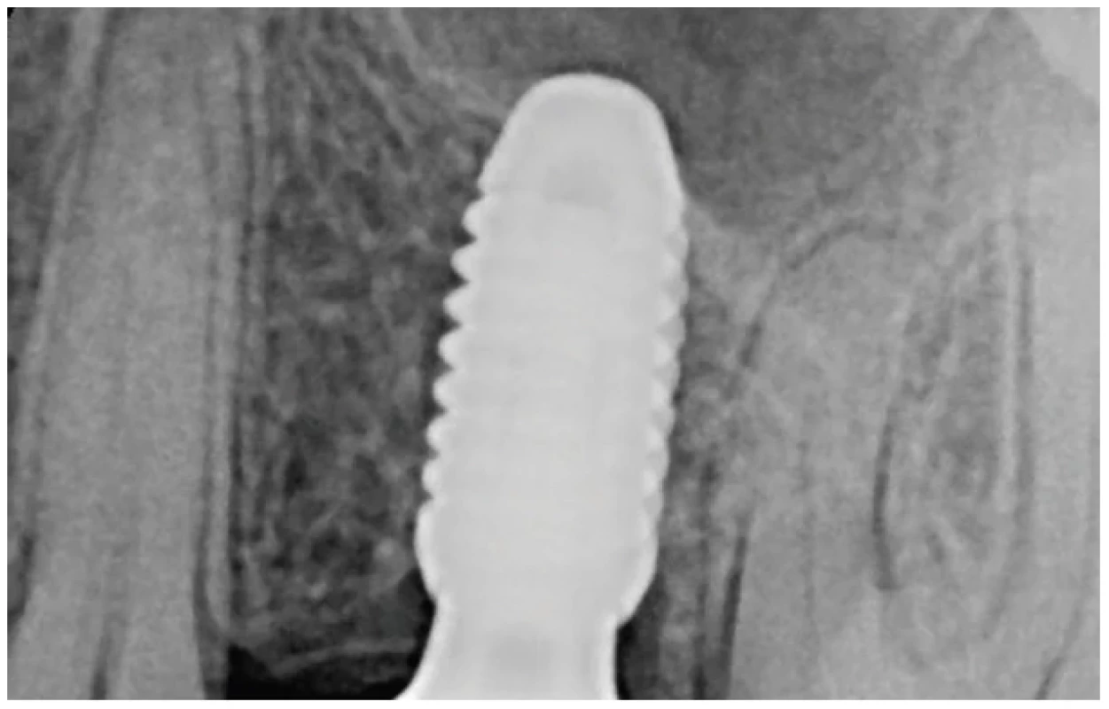 Kontrolní RTG snímek po
třech letech od implantace
ukazuje apex implantátu
a kortikaci recessus alveolaris <br> 
Fig. 6 Three-years post-op
radiograph showing tip of the
implant embedded through
cortex of alveolar recess