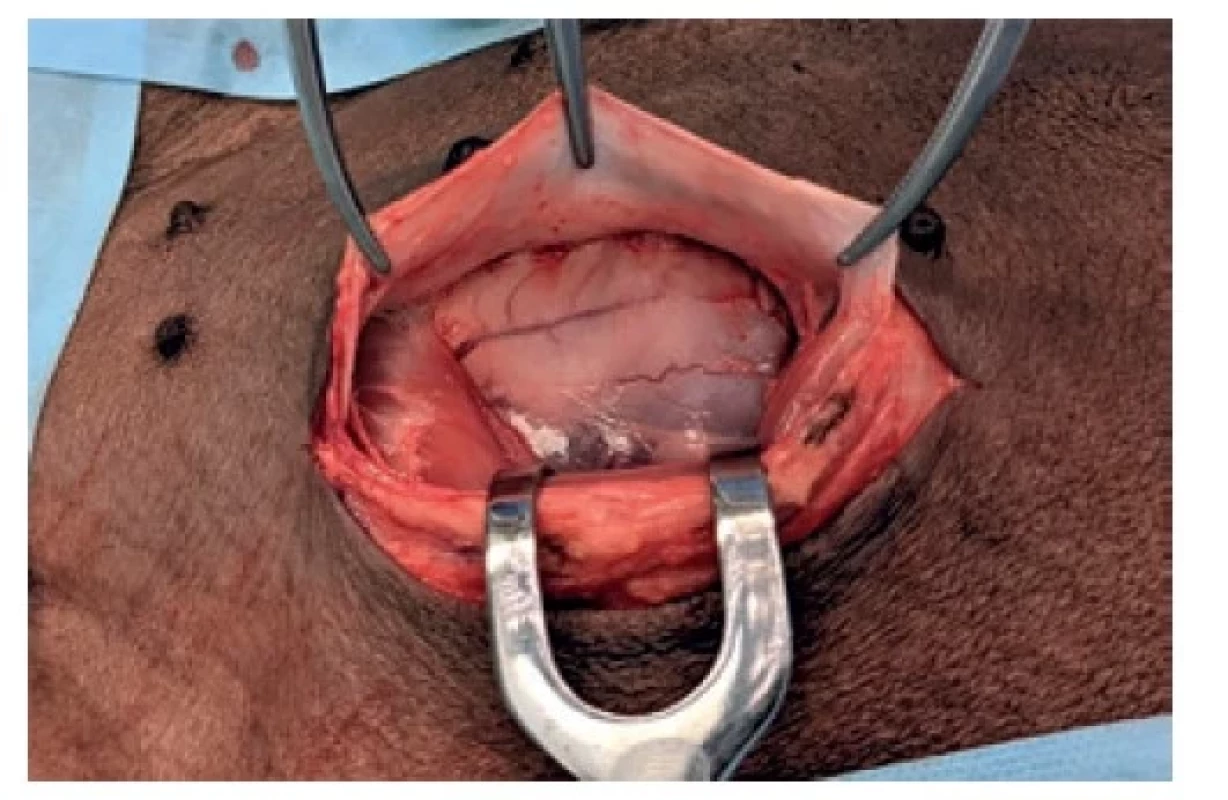 Incize, odtažený musculus rectus sinister<br>
Fig. 3: The incision; retracted left rectus muscle