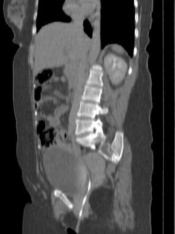 Coronel abdominal CT. <br>
Obr. 1. Koronální abdominální CT.