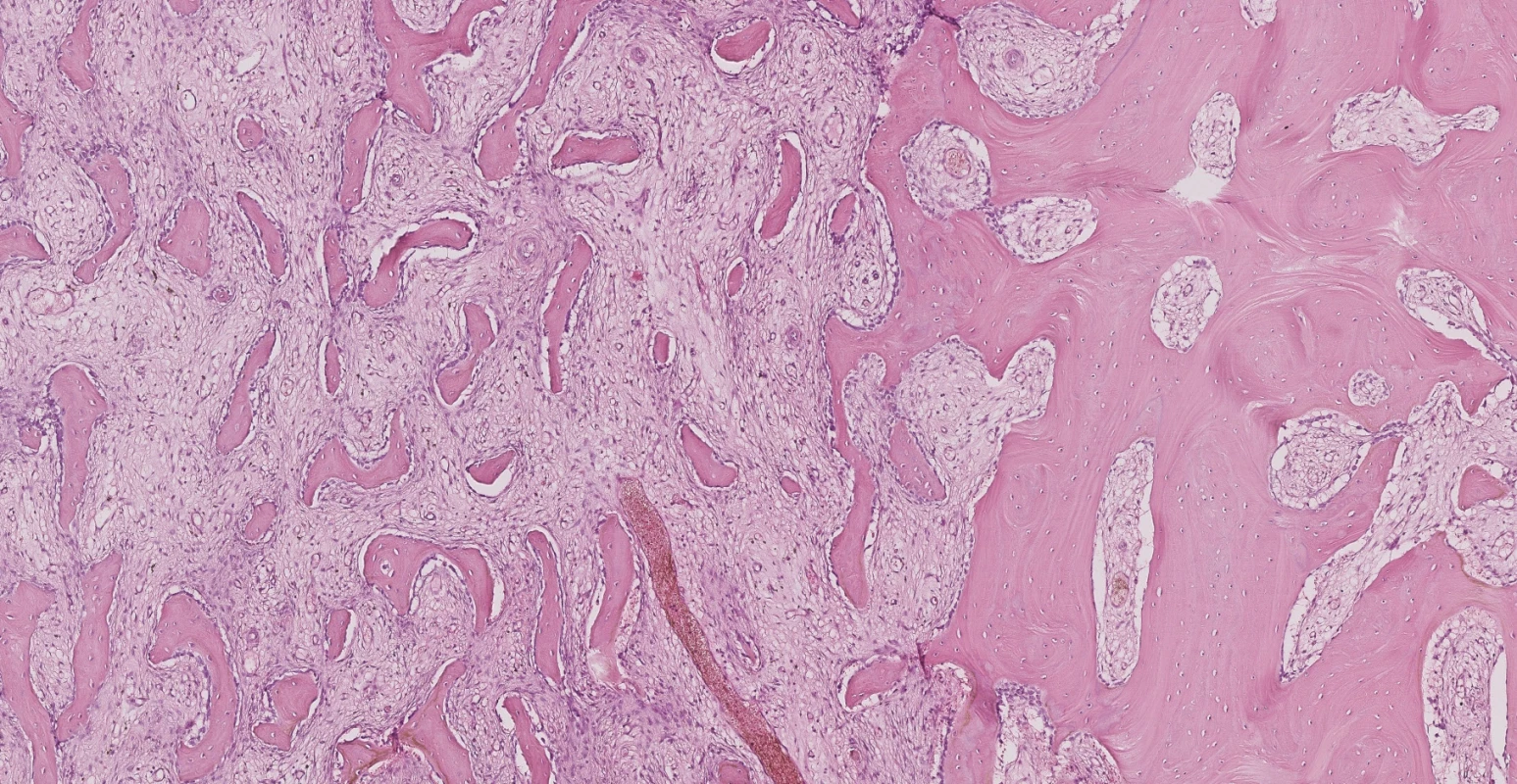 Na přiloženém snímku histologického preparátu jsou v levé části (asi 2/3 snímku) patologické změny diagnostické pro fibrózní dysplazii, v pravé části je
pro srovnání nepostižená kost, které s ložiskem sousedí
