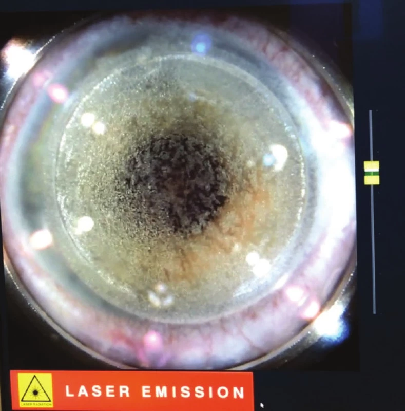Creation of corneal flap with femtosecond laser
LenSx® (Alcon, Fort Worth, Texas, USA)