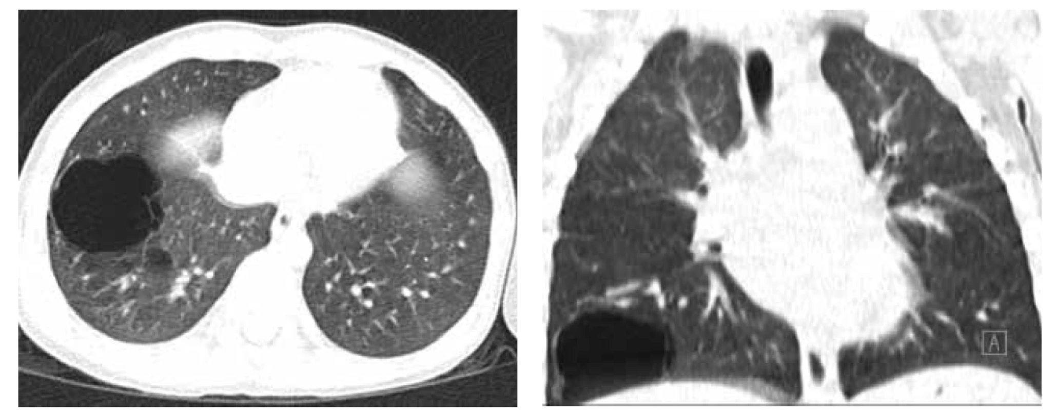 A. CT hrudníku, transverzální řez, asymptomatická CPAM PDL, prenatálně diagnostikovaná.<br>
Fig. 2A. Chest CT scan, transversal cut, asymptomatic CPAM in right lower lobe, diagnosed prenatally.<br>
Obr. 2B. CT hrudníku, koronární řez.<br>
Fig. 2B. Chest CT scan, coronary cut.