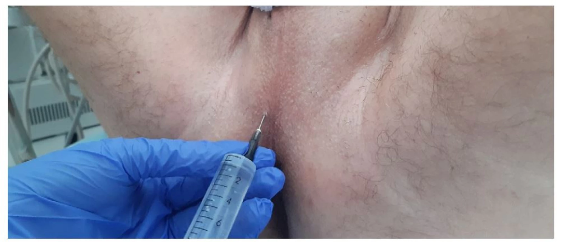 Lokální anestezie kůže a podkoží hráze (archiv autora)<br>
Fig. 1. Local anaesthesia of the perineal skin and subcutaneous tissues (author’s archive)