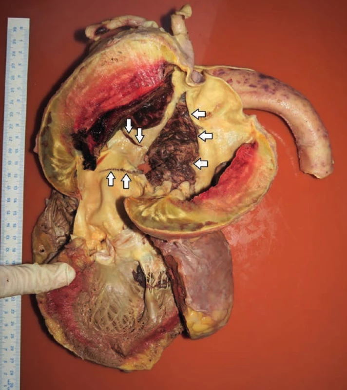 The view of the left ventricular outflow tract, ascending aorta and aortic
arch showing chronic dissection with intramural hematoma and isolated
defects in the aorta’s wall. Defect no. 1 (arrows pointing upwards). Defect no.
2 (arrows pointing downwards). Defect no. 3 (arrows pointing to the left).