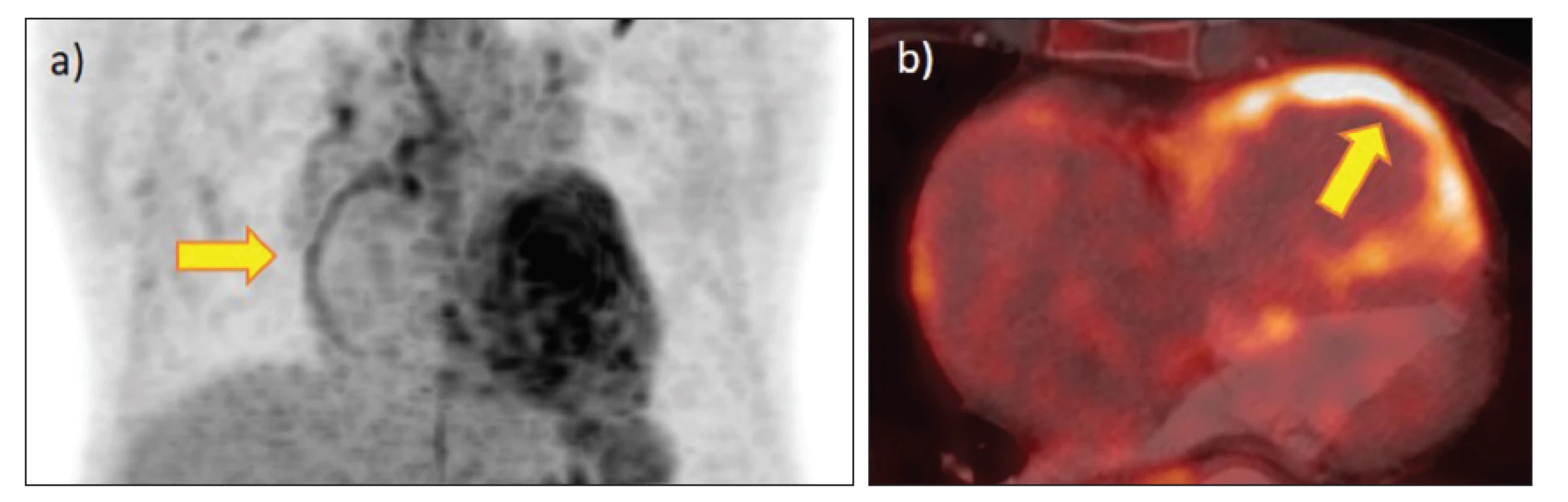 FDG PET/CT u 69letého pacienta s těžkou tromboembolickou plicní hypertenzí, vyšetřovaného pro susp. plicní tumor – dilatovaná,
hypertrofická pravá komora se zvýšenou akumulací FDG (šipky): a) MIP, b) fúze PET/CT.