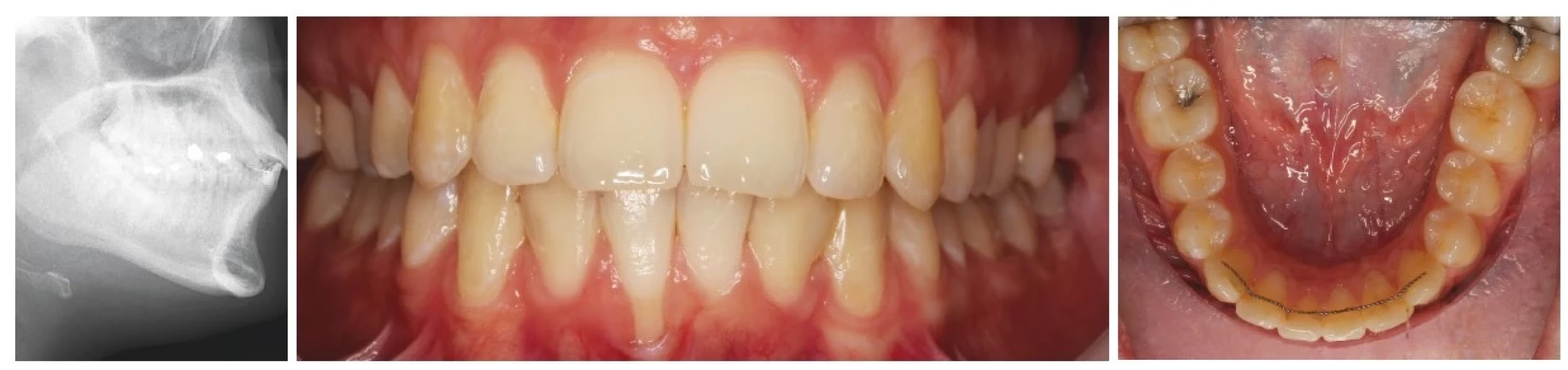 a, b, c
Stav v retenční fázi.
Gingivální recesus na zubu 41
jako neočekávaná komplikace
fixního retaineru.<br>
Fig. 4a, b, c
Condition at the phase of
retention. Gingival recession
on tooth 41 as an unexpected
complication of a fixed
retainer.