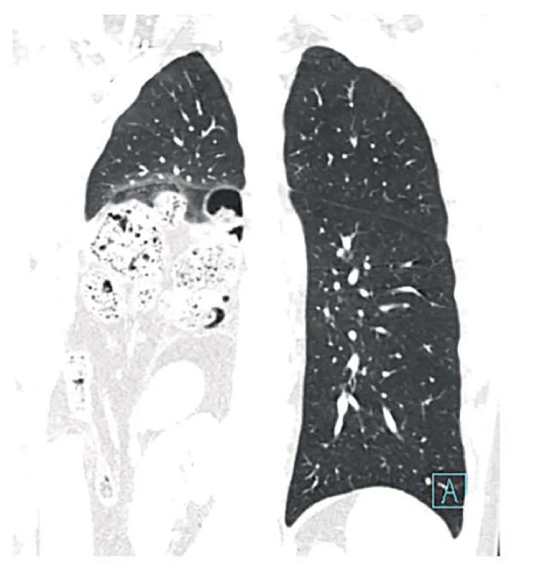 Herniace břišních orgánů do pravého hemithoraxu
na CT<br>
Fig. 3: Herniation of abdominal organs in the right hemithorax
based on CT
