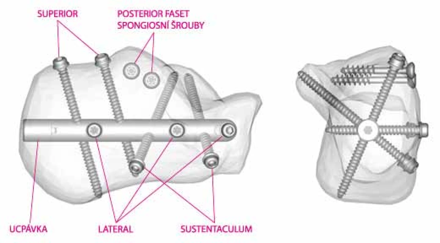 Schéma umístění hřebu (Operační technika C-Nail – www.c-nail.eu)