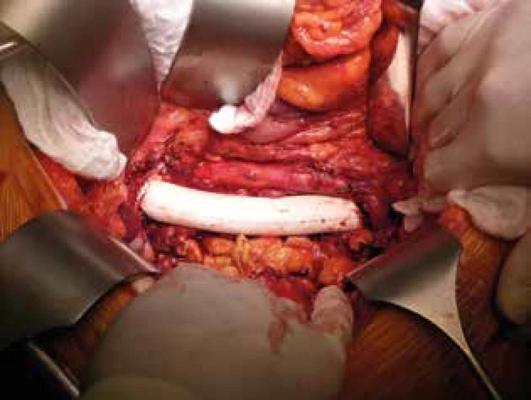 Stav po kompletnej resekcii dolnej dutej žily s náhradou polytetrafluóretylenovým interpozitom <br>Fig. 3: State after complete resection of the inferior vena cava with replacement using a polytetrafluoroethylene interposition graft
