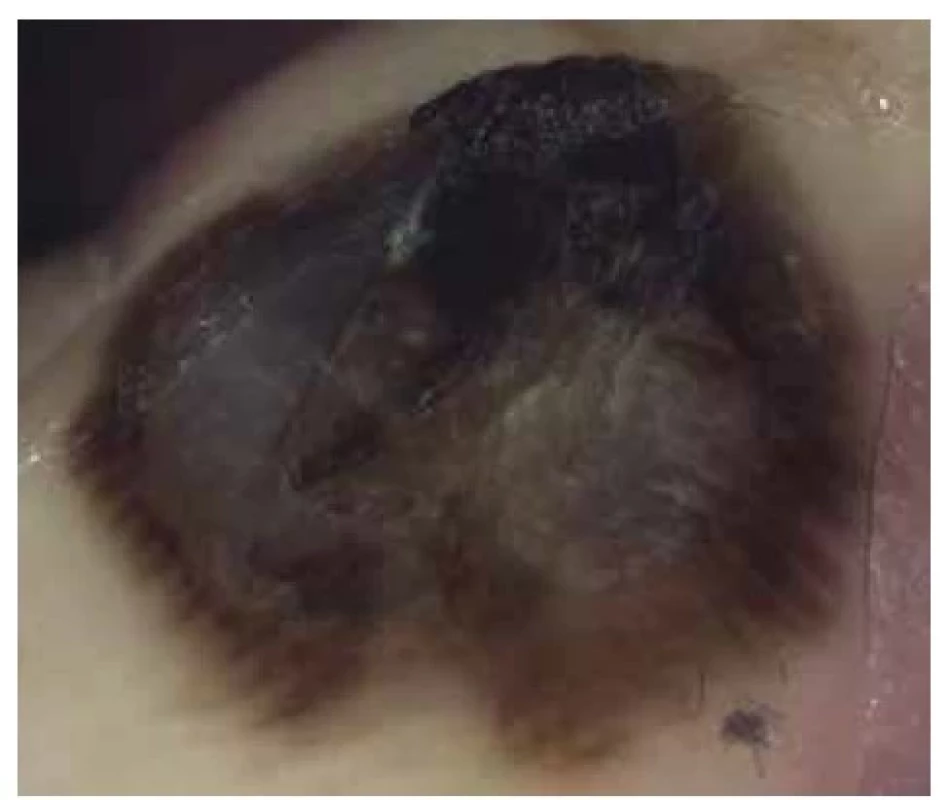Maligní melanom 1,1 mm s regresí<br>
Projev je větší než 1 cm v průměru, v centru bezstrukturní okrsky
s difuzní šedomodrou nebo bělavou pigmentací, při okrajích široká
lineární pigmentace nad cristae superficiales.